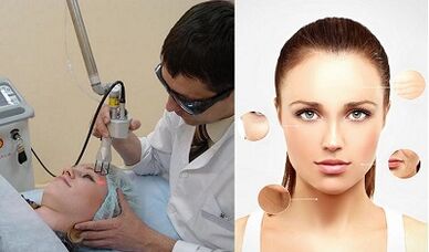 Cómo se realiza el rejuvenecimiento cutáneo con láser